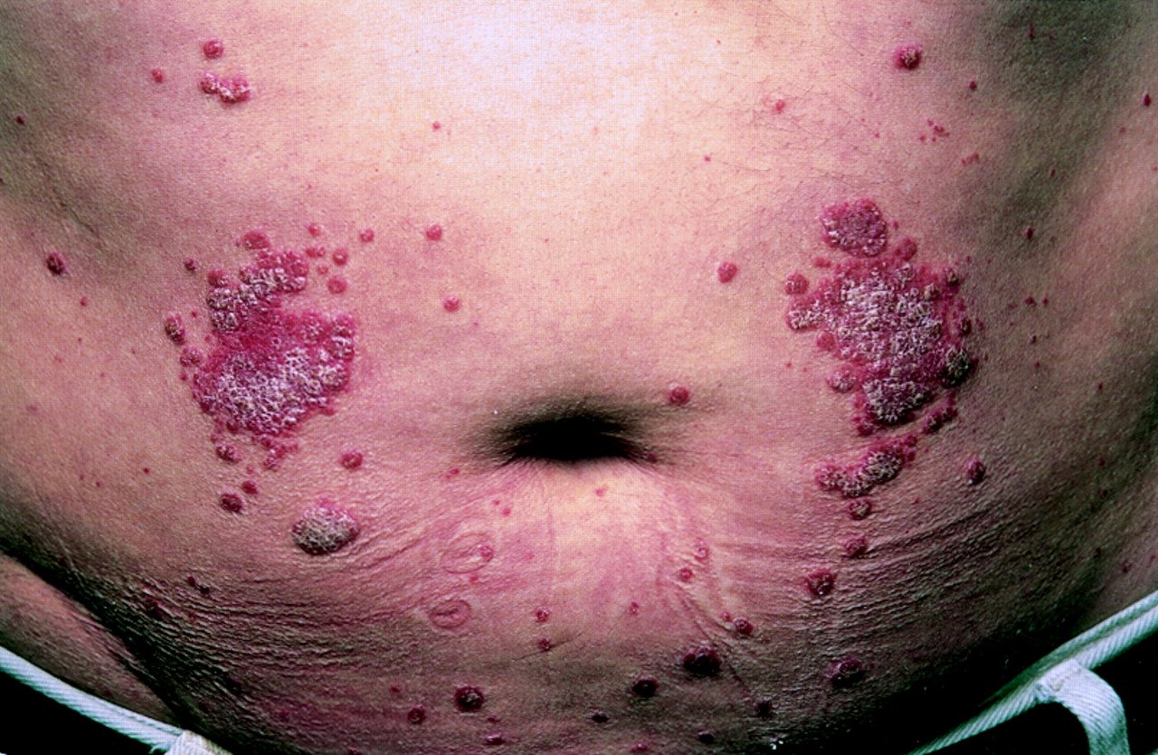 Extensive psoriasis induced by interferon alfa treatment ...