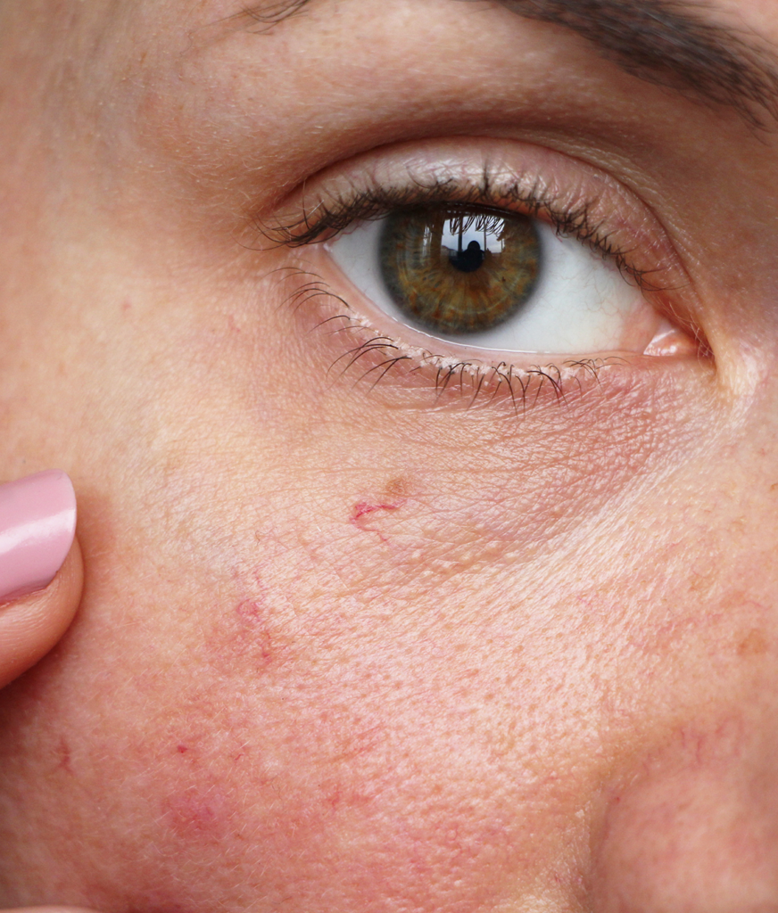Facial Redness Treatments