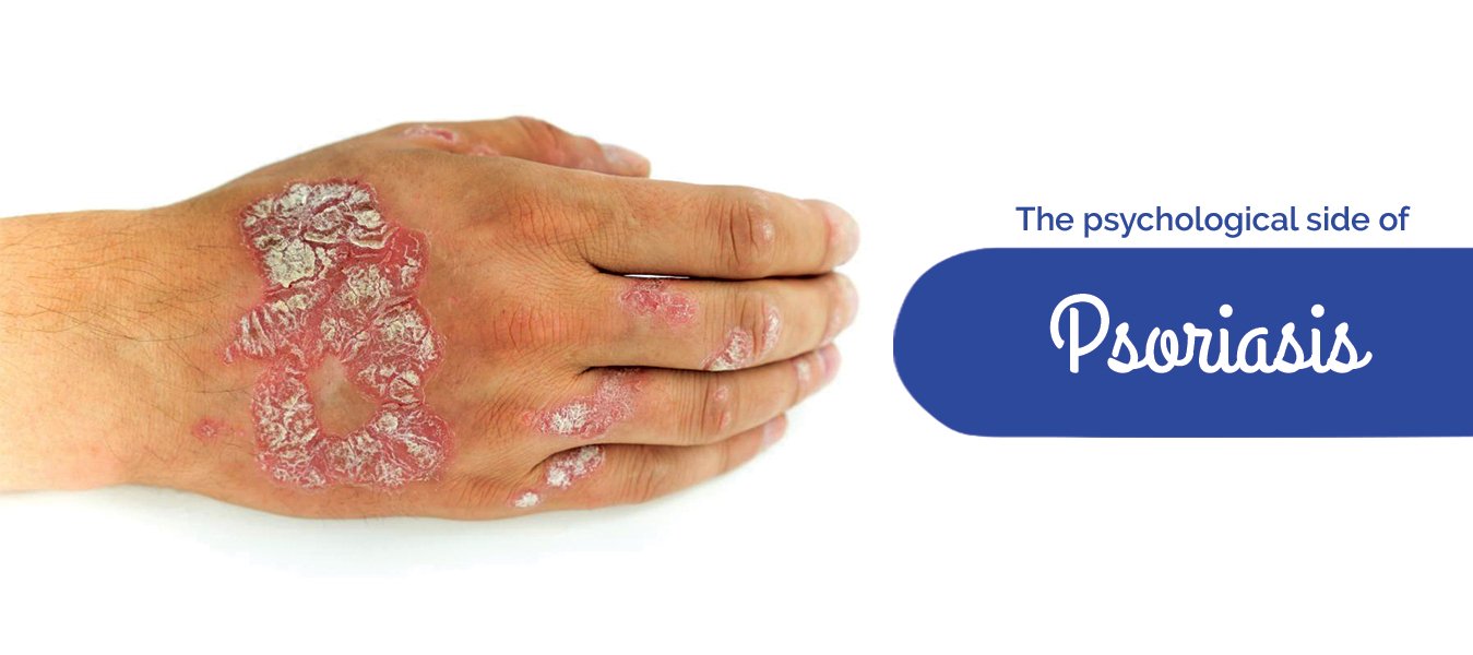 Facts your never knew about Psoriasis