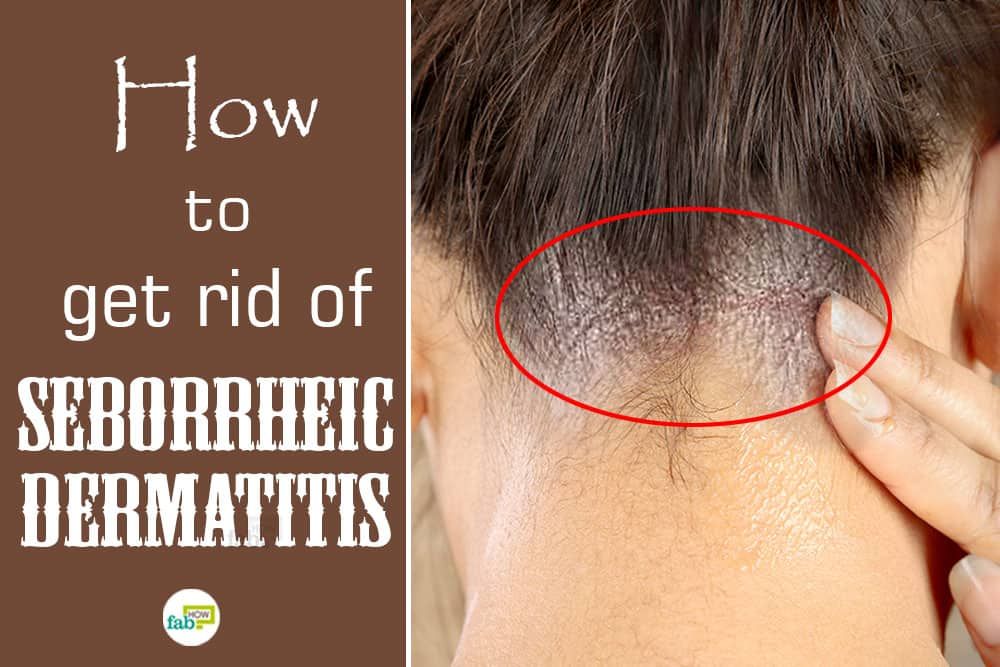 feat how to get rid of seborrheic dermatitis