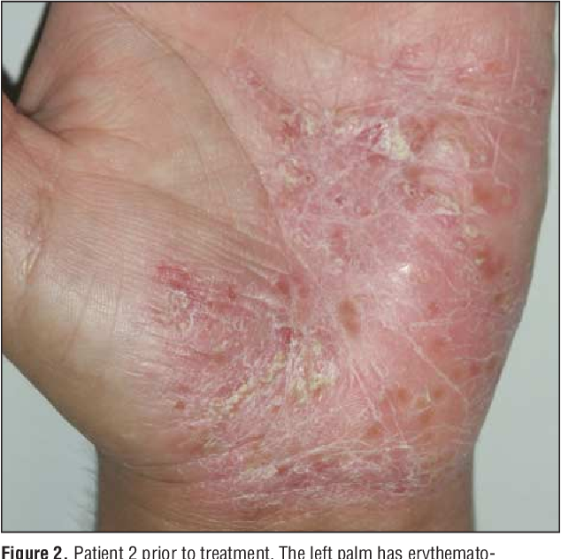 Figure 2 from Leflunomide in the treatment of palmoplantar pustulosis ...