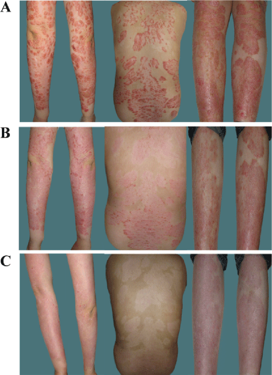 Figure 2 from Successful Treatment of Severe Psoriatic ...