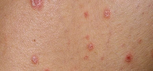 First Signs Of Psoriasis Pictures