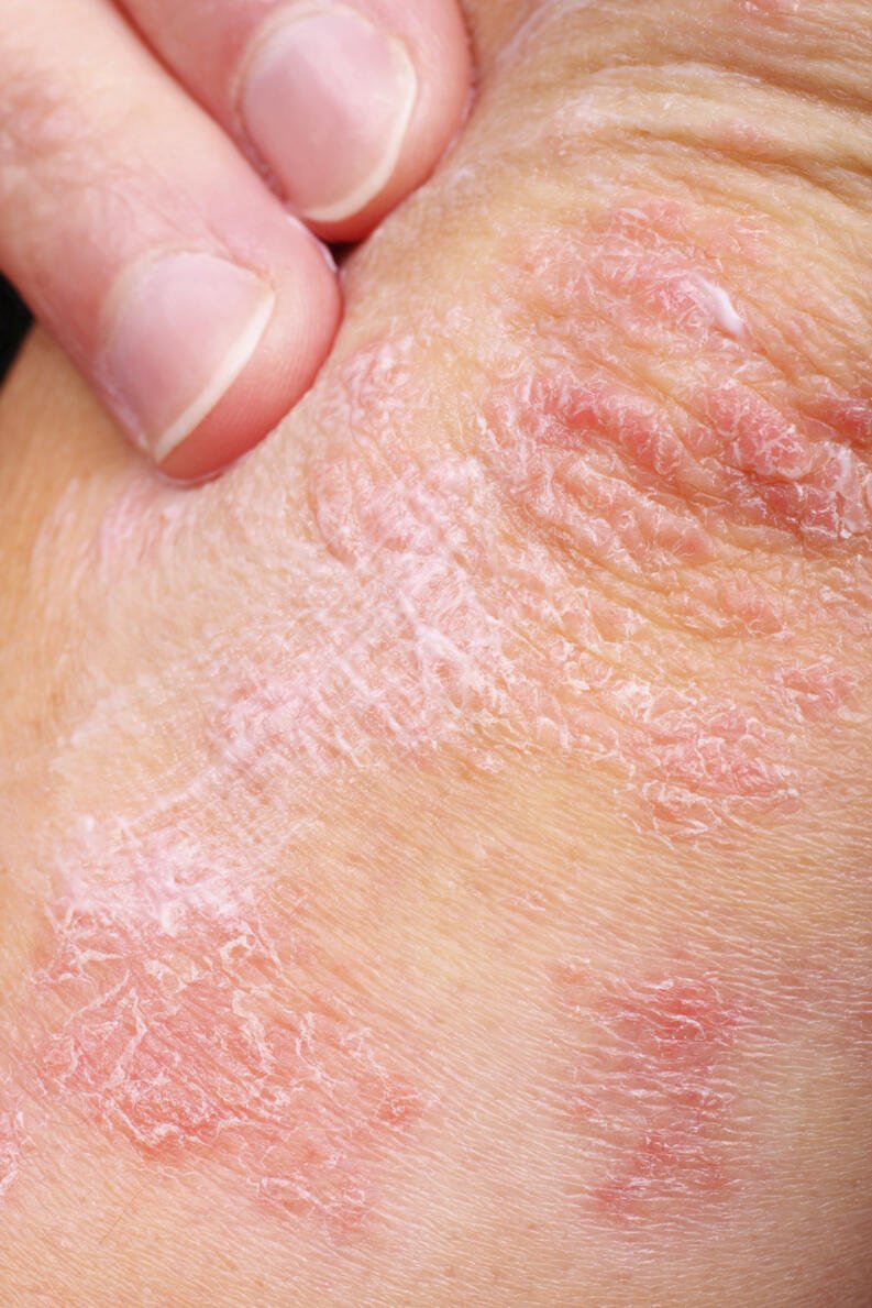 Fotos de enfermedades de la piel