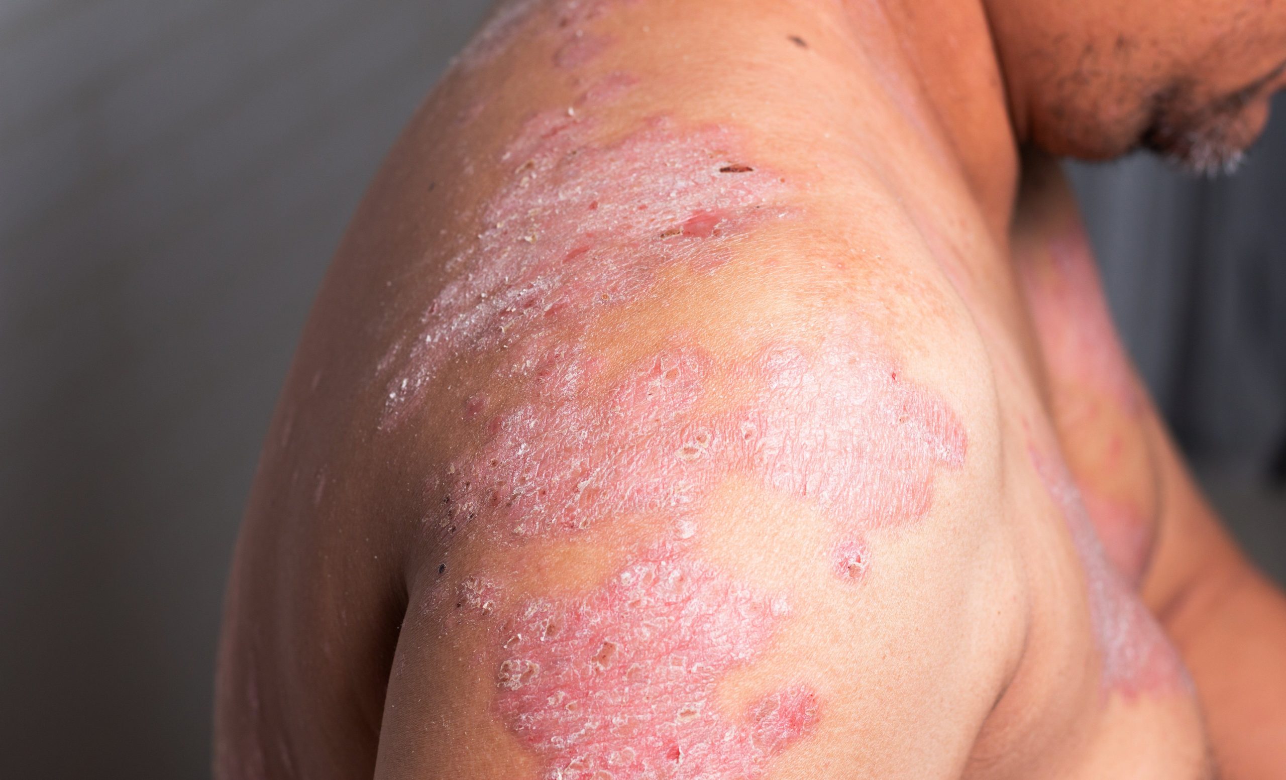 Guidance on transitioning psoriasis patients between biologics