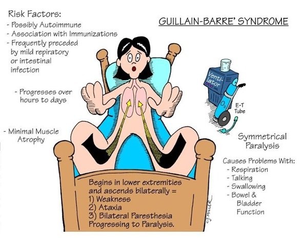 Guillain Barre Syndrome Causes, Symptoms, Diagnosis and ...