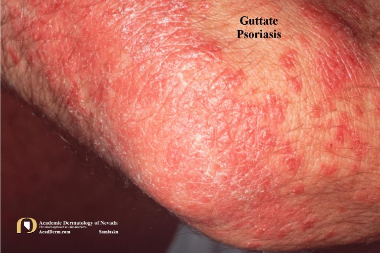 Guttate Psoriasis: A Shower of Scaly Teardrops...