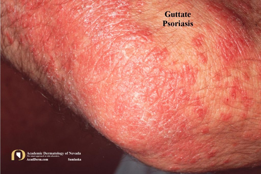 Guttate Psoriasis: A Shower of Scaly Teardrops ...