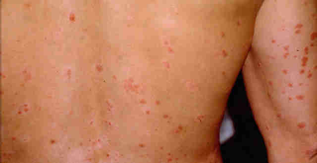 Guttate Psoriasis â Why To Treat At Home? 2018