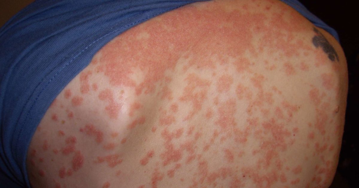 Guttate psoriasis: Causes, symptoms, and treatment