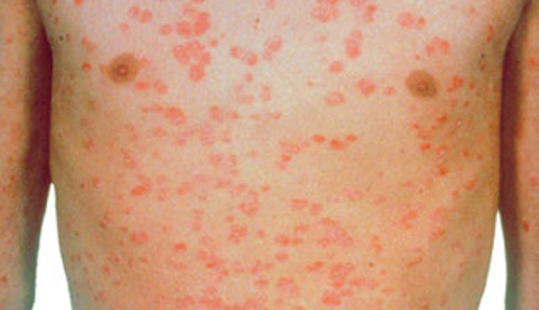 Guttate Psoriasis: Causes, Symptoms and Treatments: National Psoriasis ...
