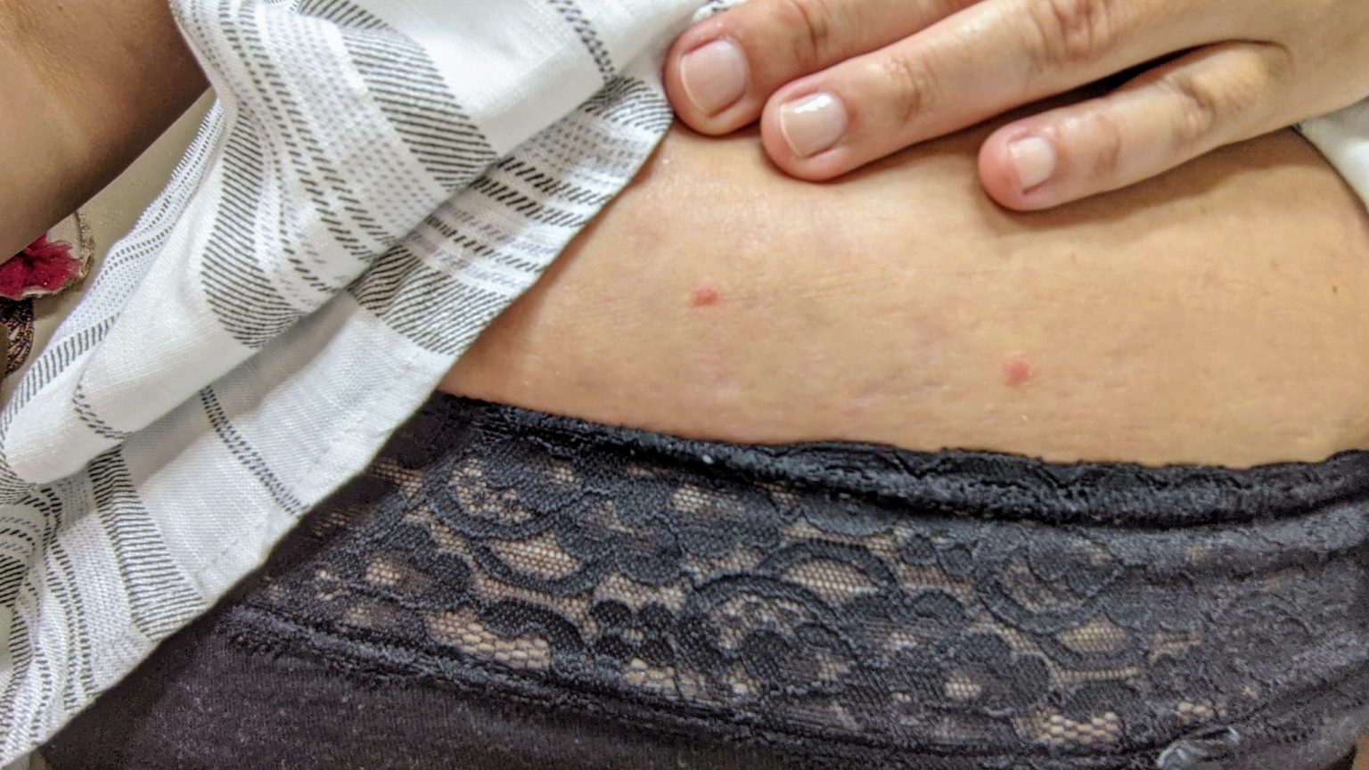 Guttate Psoriasis Coming Back (Pics and Story)