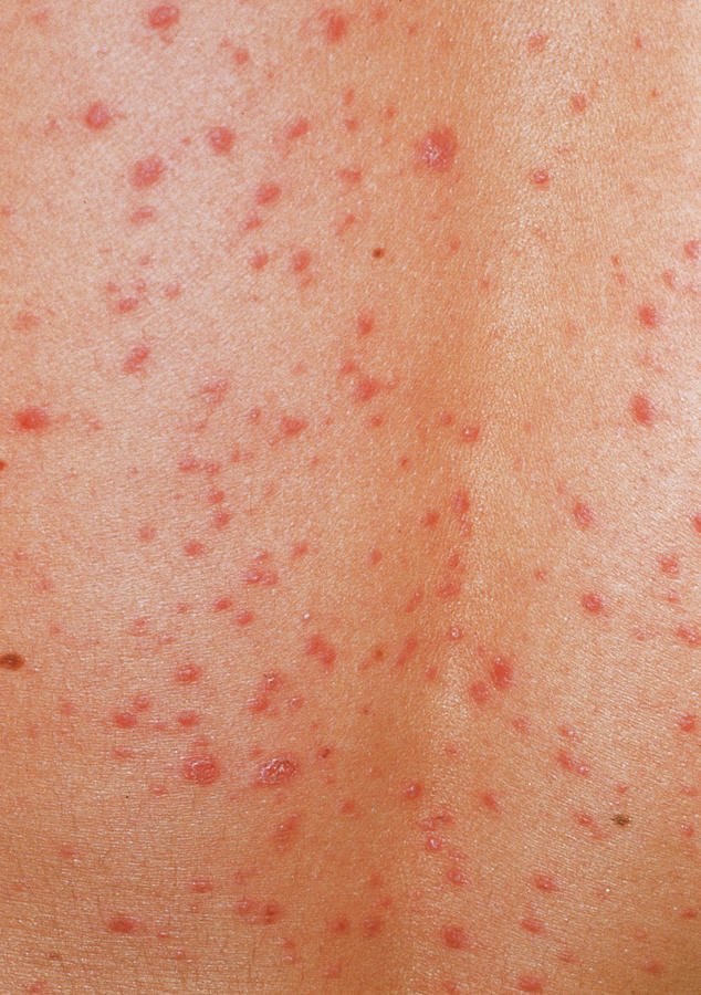 Guttate Psoriasis Skin Rash Photograph by Cnri/science ...
