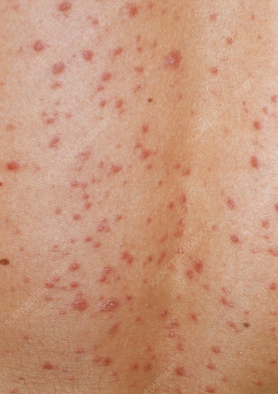 Guttate psoriasis skin rash