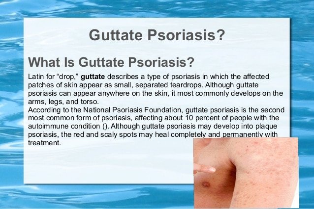Guttate psoriasis