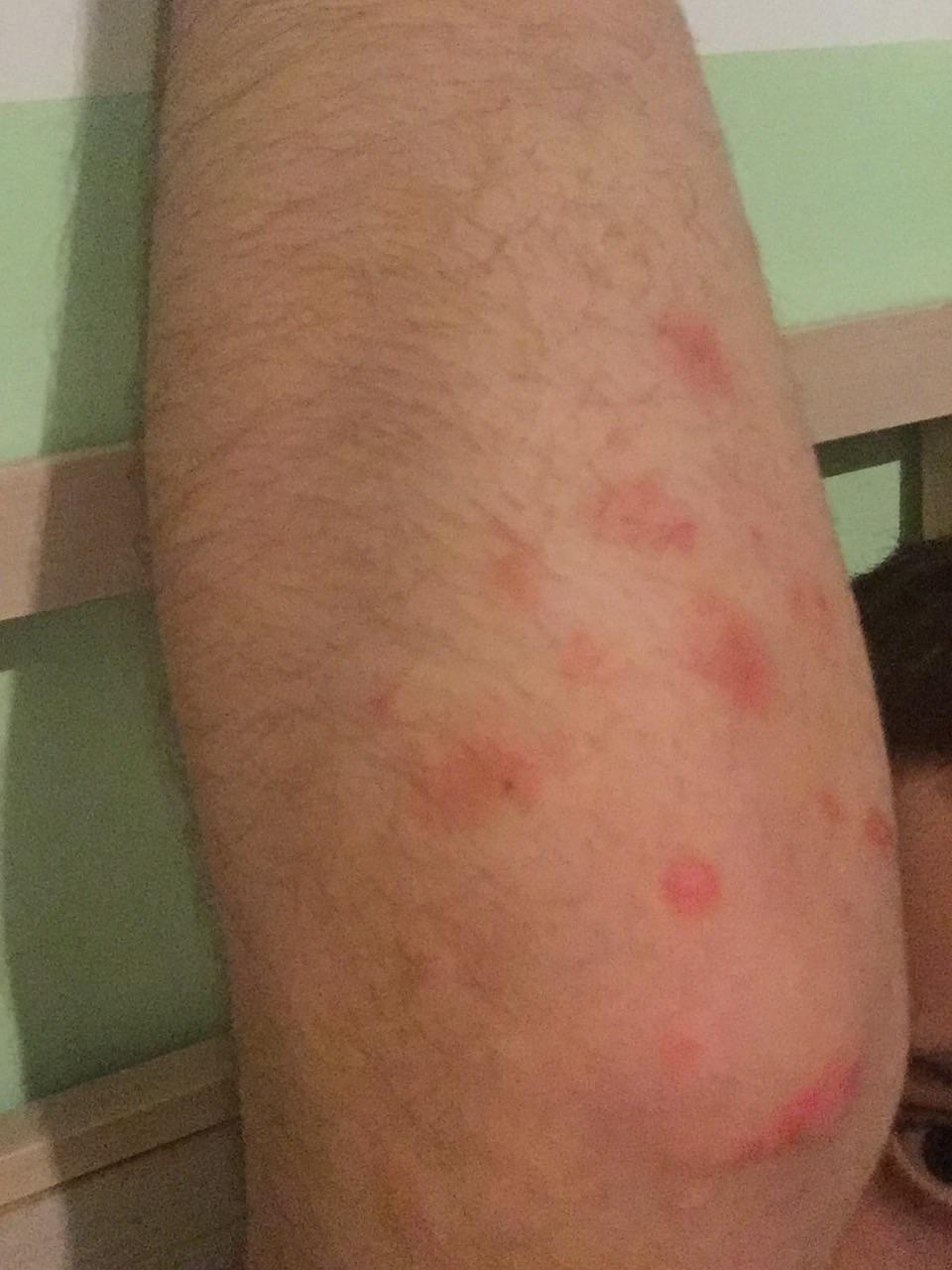 Had this on my elbow around a month ago, i tought it was a ...
