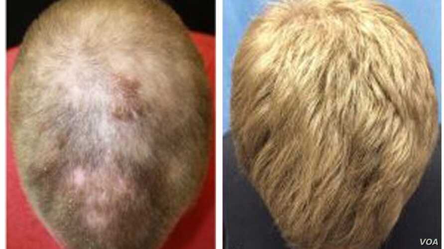 Hair Loss Due To Psoriasis : Pdf Alopecia Areata And ...