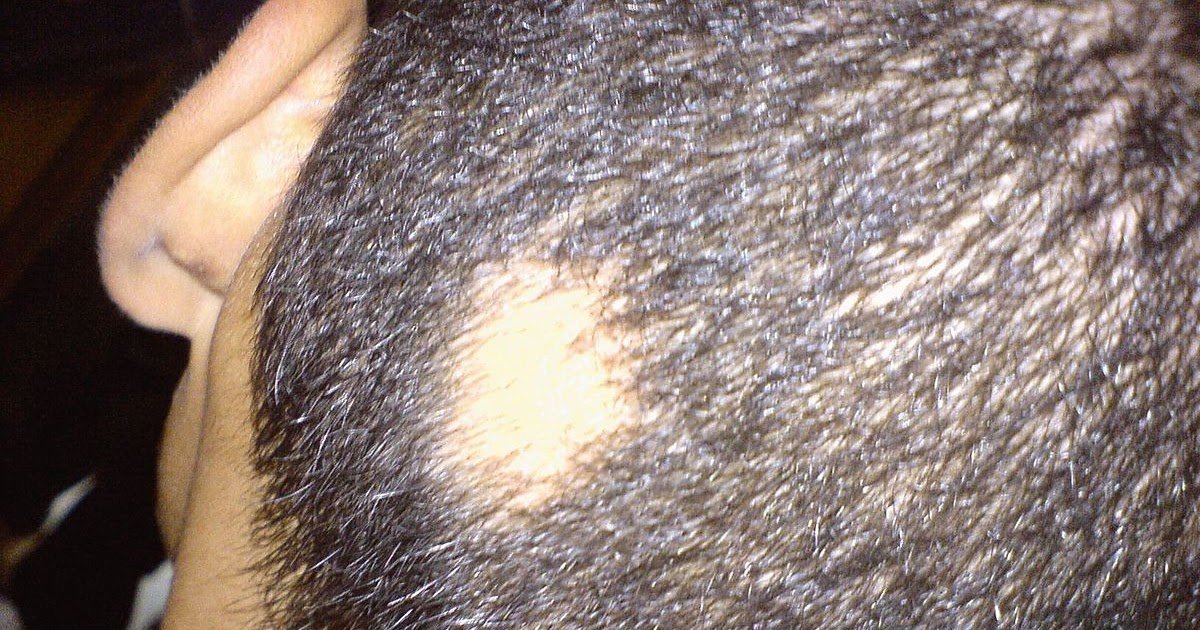 Hair Loss Due To Psoriasis Scalp : Scalp Psoriasis Before And After ...