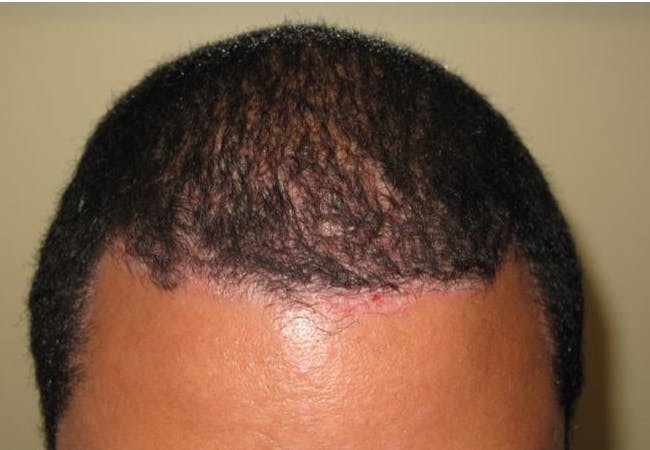 Hair Loss Due To Psoriasis Scalp : Scalp Psoriasis Before ...