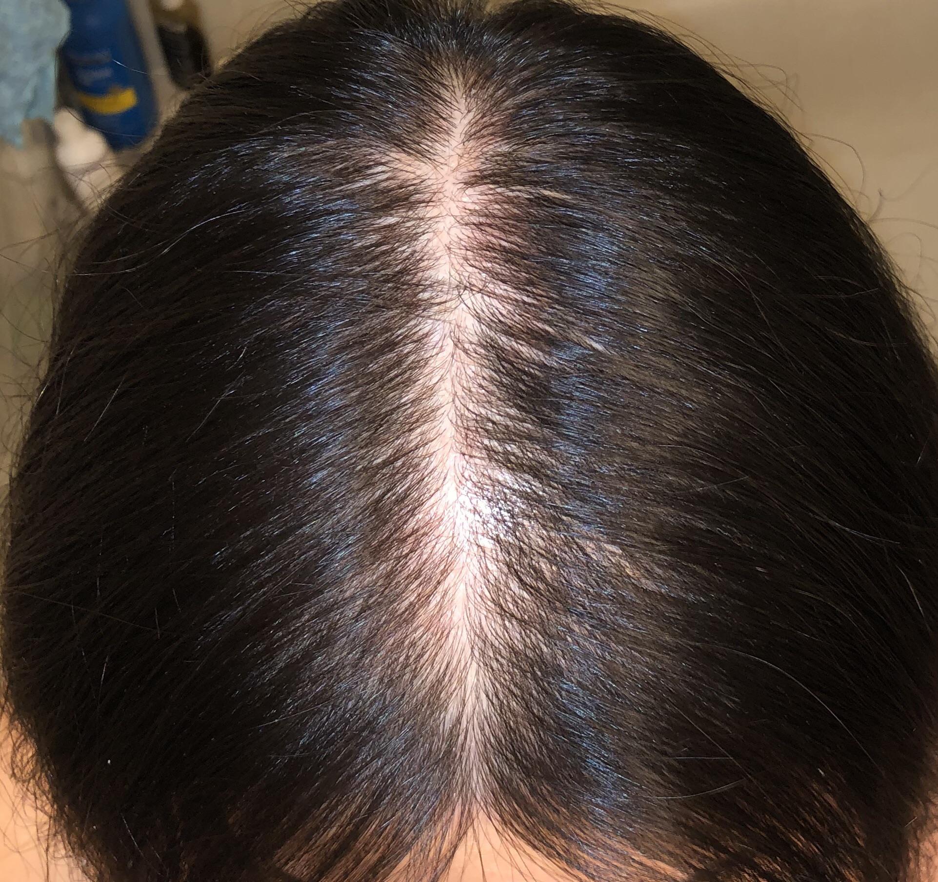 Hair Loss From Psoriasis