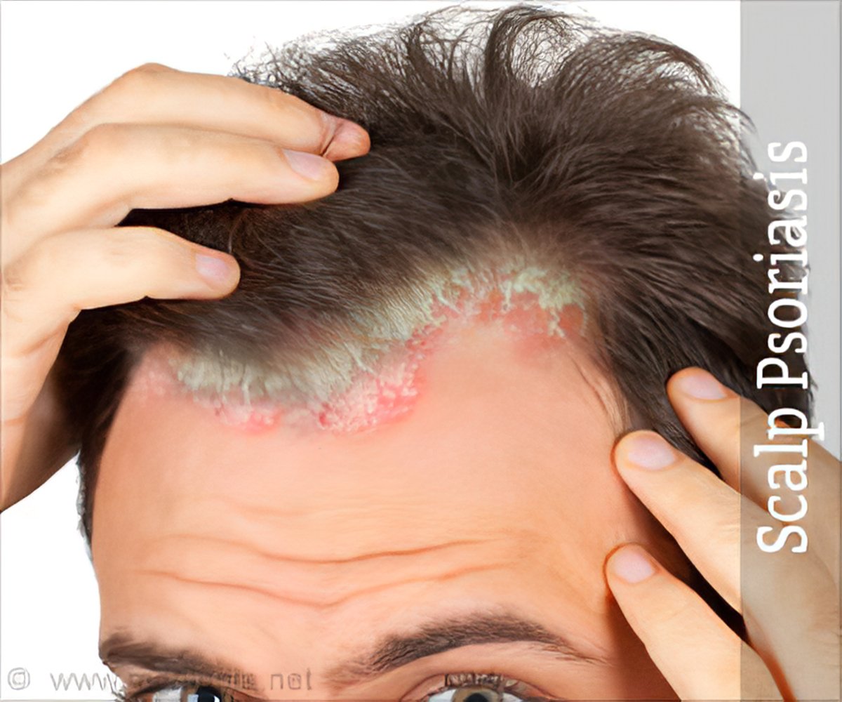 Hair Loss Scalp Psoriasis : Folliculitis Scalp Symptoms Pictures ...