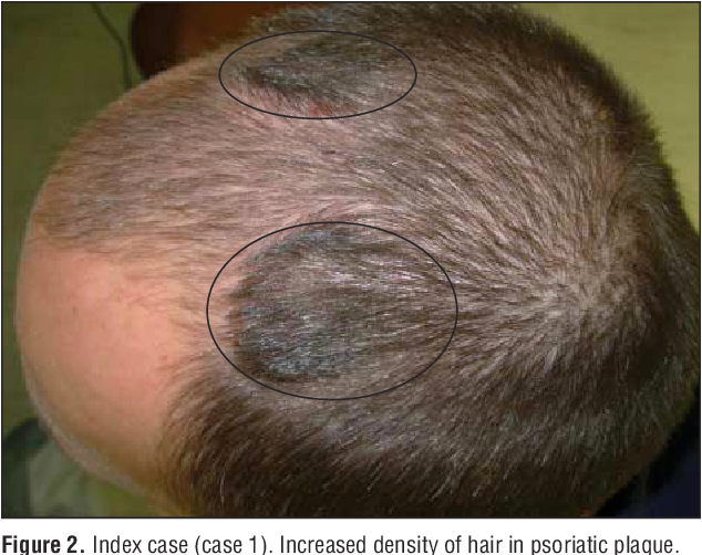 Hair Loss Scalp Psoriasis : Folliculitis Scalp Symptoms Pictures ...