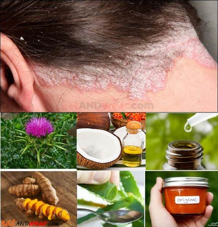 Hair Scalp Psoriasis: Natural Remedies &  Medical ...