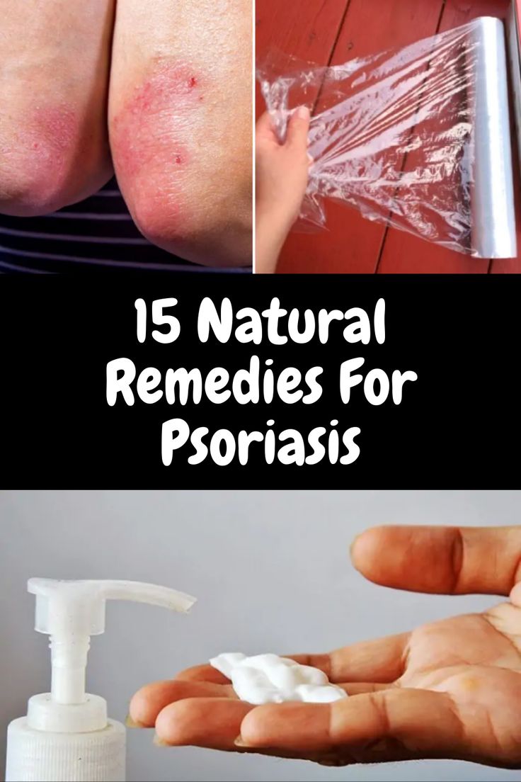 Have Psoriasis? Everything You Need To Know To Naturally ...