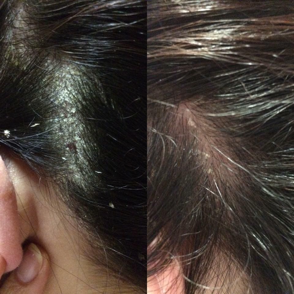 Help scalp psoriasis with Monat