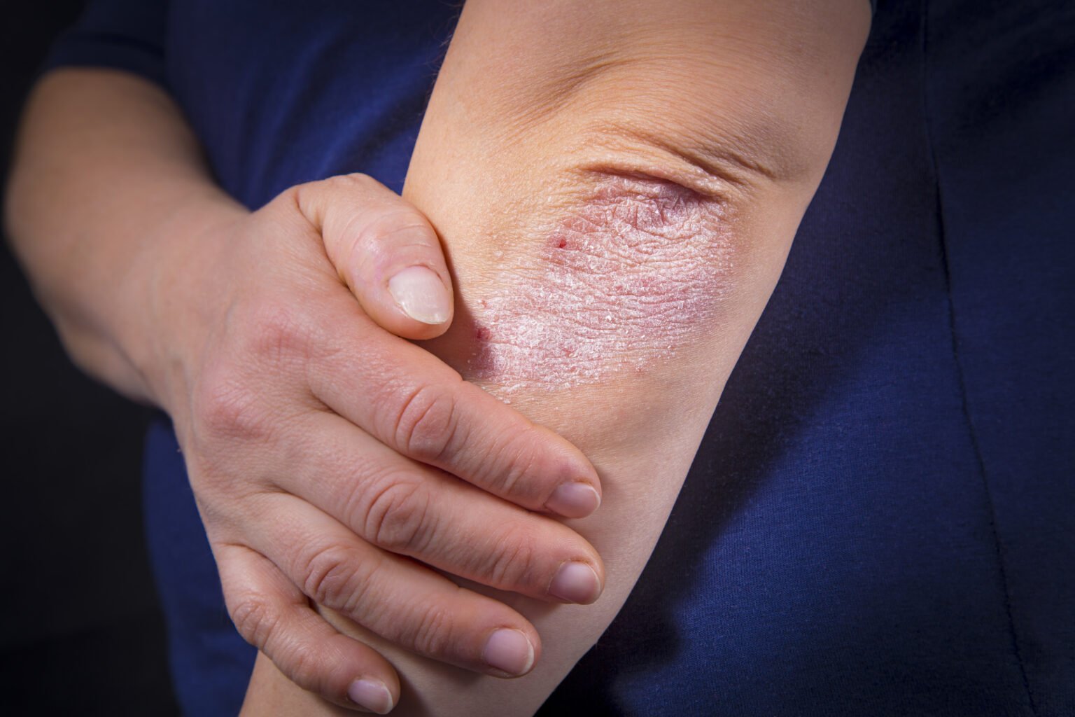 Here Are Four Easy Ways To Manage A Psoriasis Flare Up