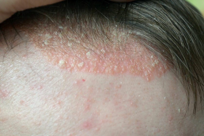 Heres everything you didnt know about scalp psoriasis ...