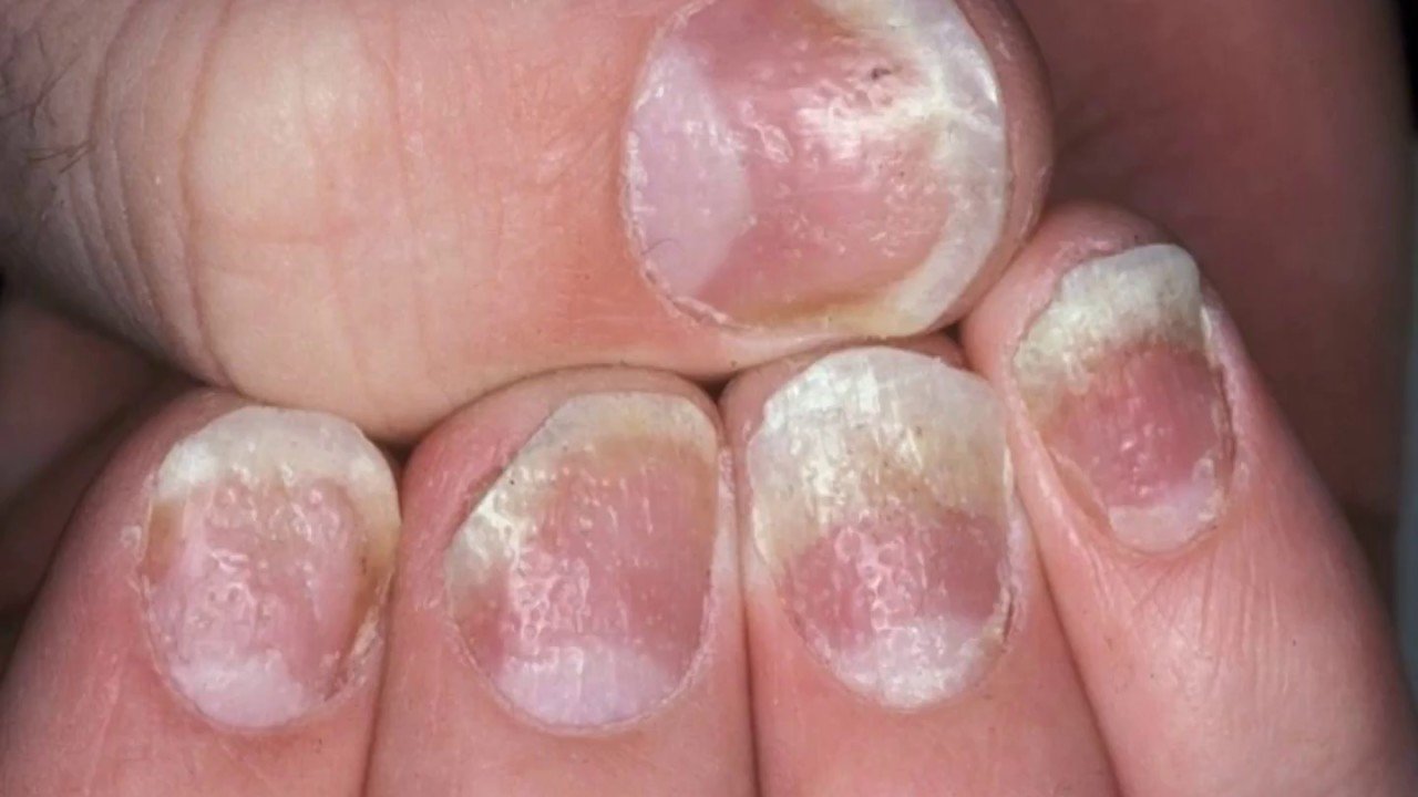 HOME REMEDIES FOR NAIL PSORIASIS