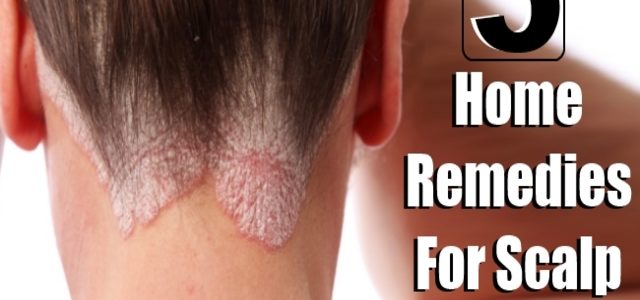 Home Remedies For Plaque Psoriasis Scalp