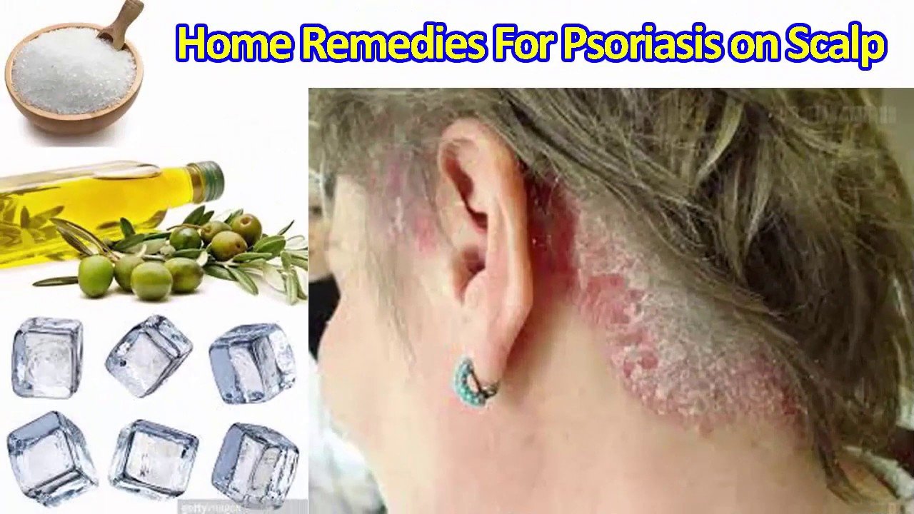 Home Remedies for Psoriasis on Scalp