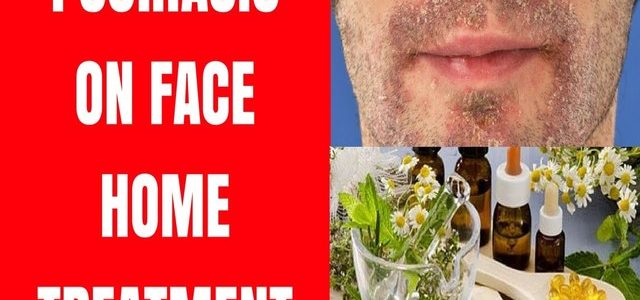 Home Remedies For Psoriasis On The Face