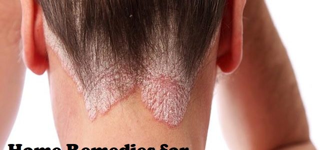 Home Remedies For Scalp Psoriasis Itching