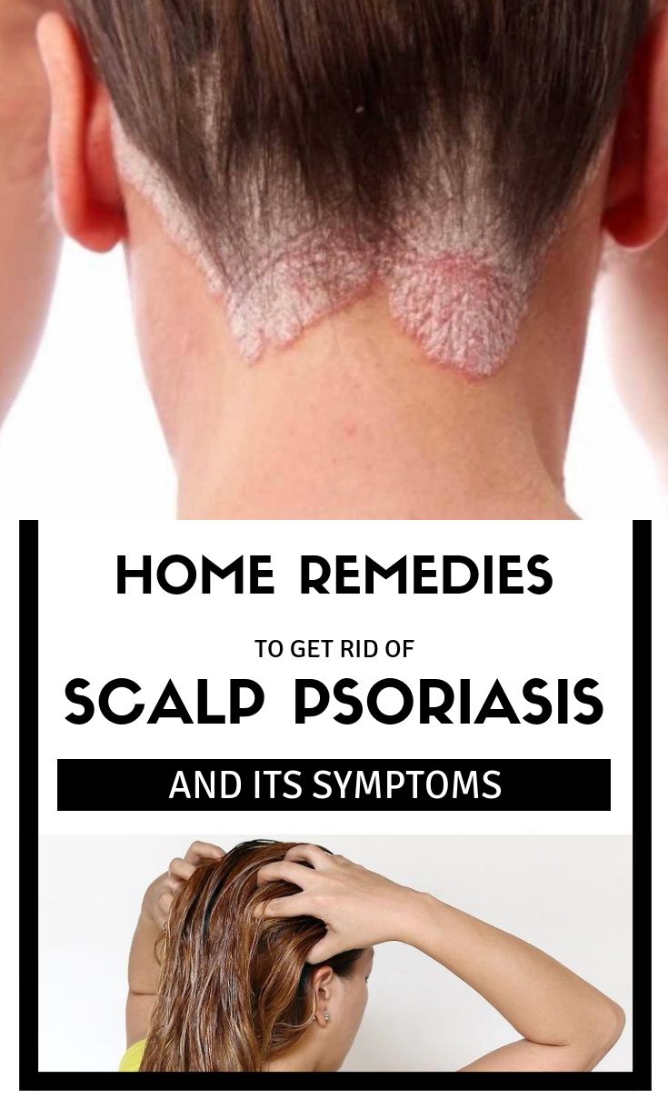 Home Remedies To Get Rid Of Scalp Psoriasis And Its ...