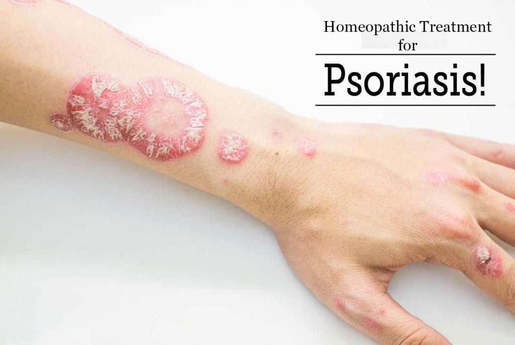 Homeopathic Medicine for Psoriasis â Psoriasis Treatment in Homeopathy
