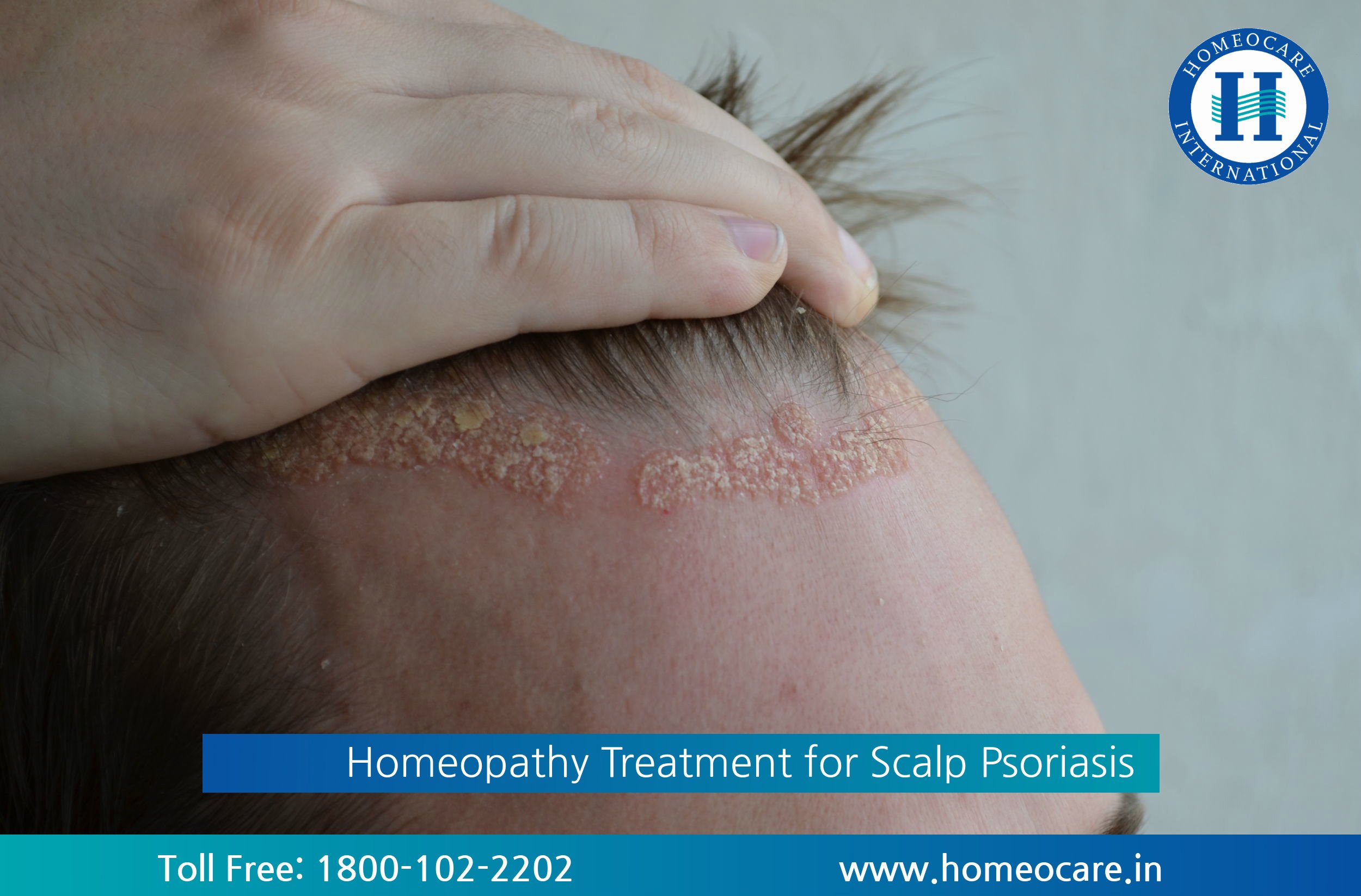 Homeopathy Treatment for Scalp Psoriasis Disorder  Online Homeocare