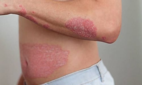 How Can I Treat my Psoriasis?