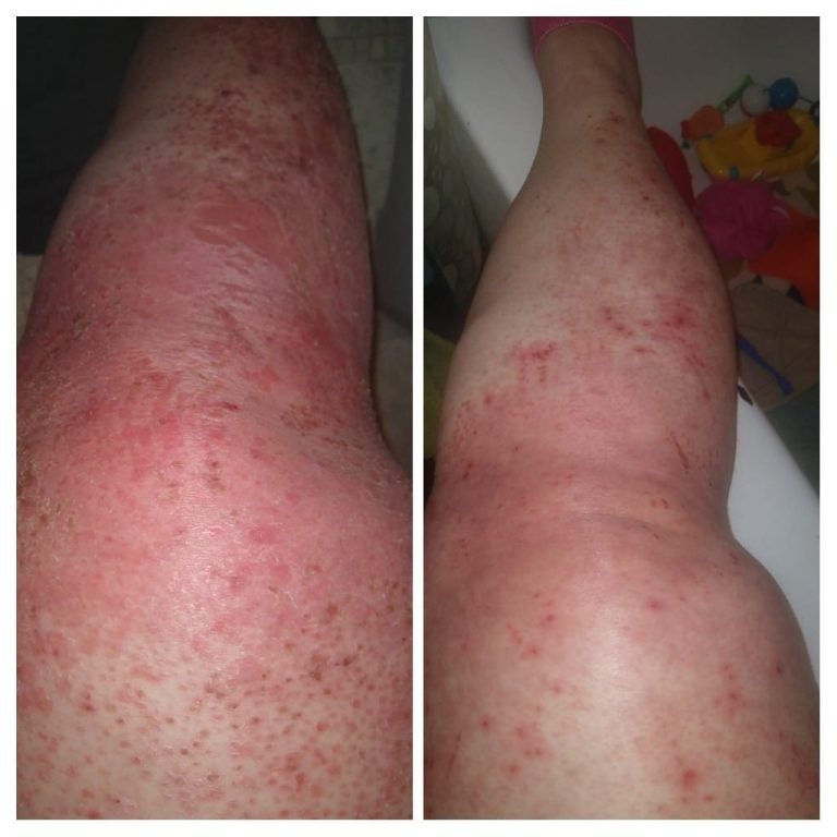 How do I Get rid of Psoriasis on My Legs (PICS)