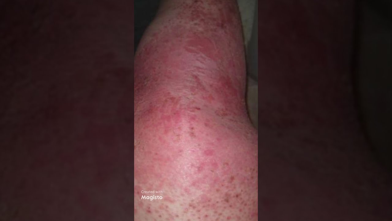 How do I Get rid of Psoriasis on My Legs
