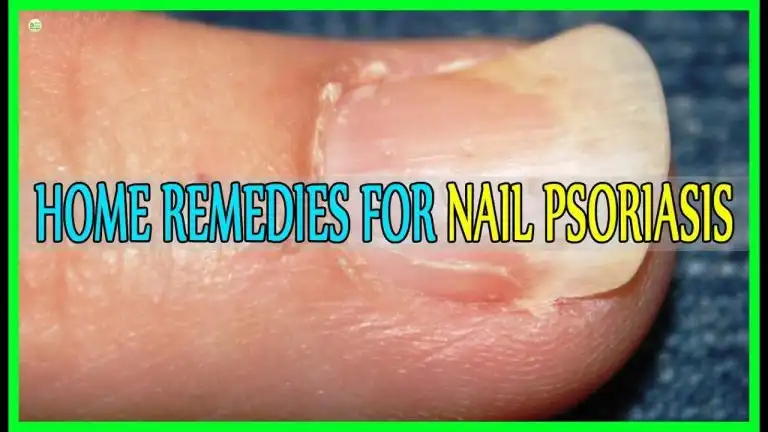 How Do I Get Rid Of Psoriasis On My Nails