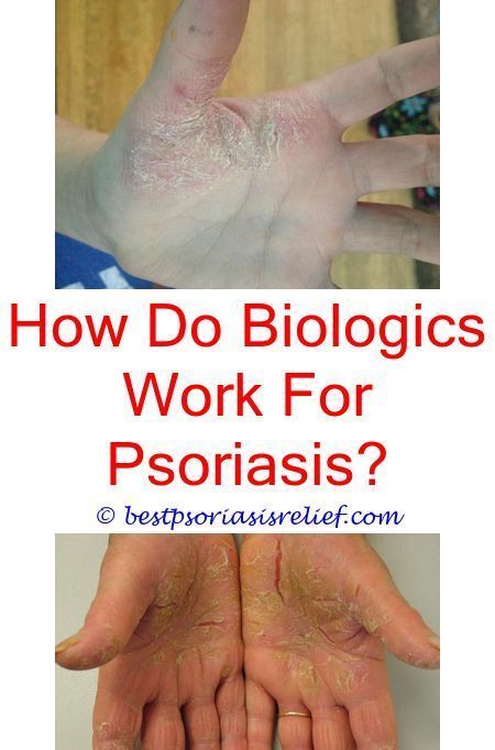 How Do I Get Rid Of Psoriasis On My Scalp