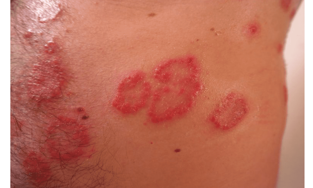 How Do You Get Plaque Psoriasis?: Colorado Skin Care: Dermatology