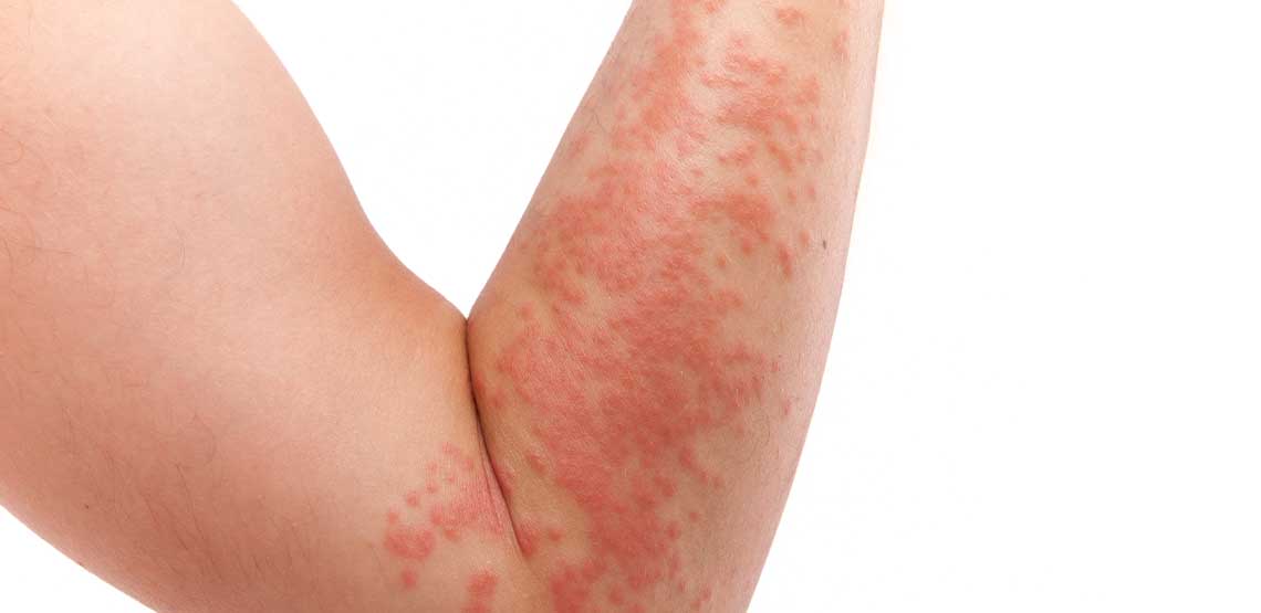 How Do You Get Psoriasis: Potential Causes and Risk Factors