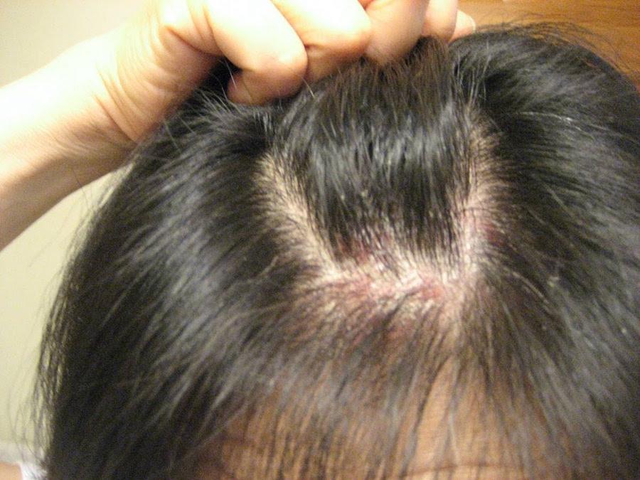 How Do You Know If You Have Scabies In Your Hair And Scalp ...