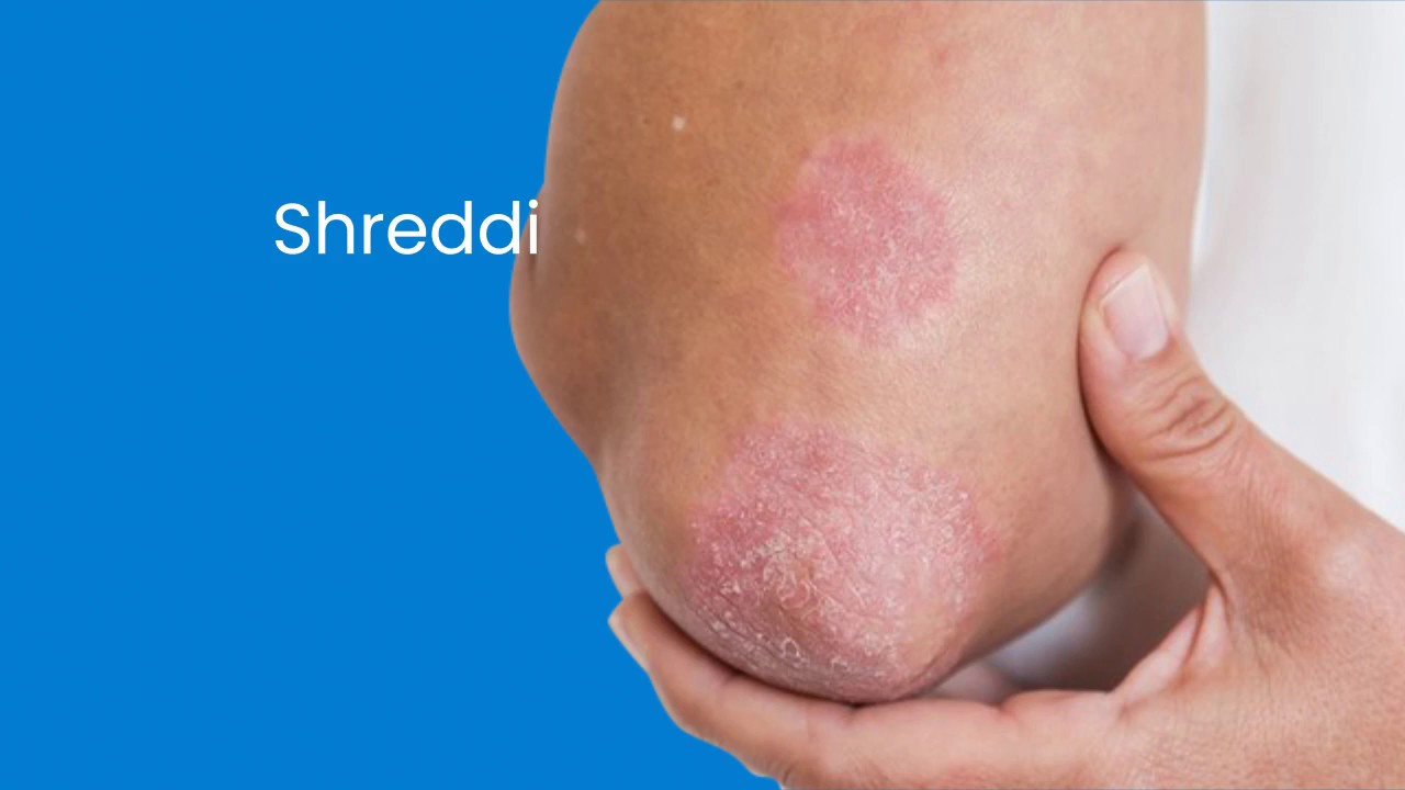 How Do You Stop Psoriasis From Spreading? Homeopathy ...