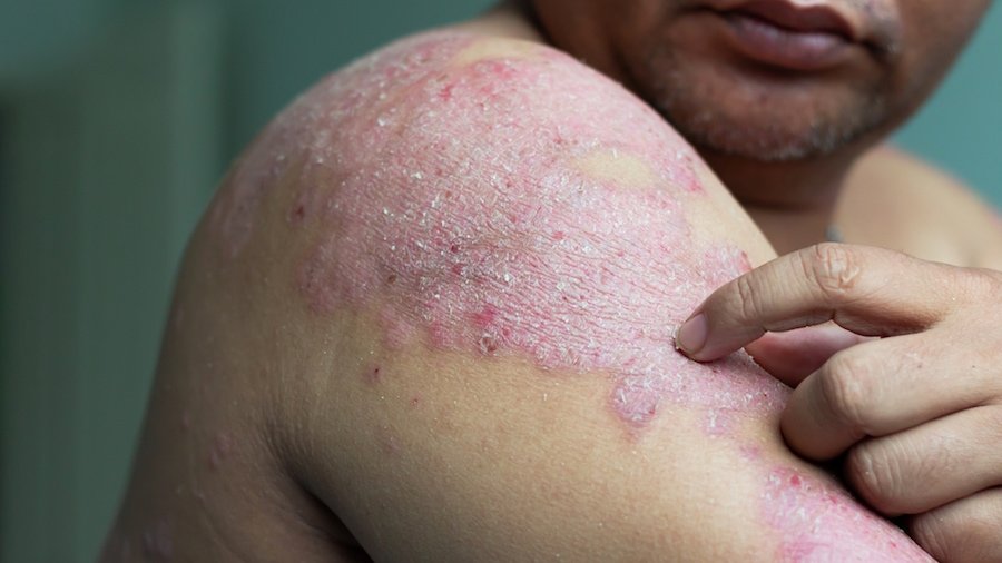 How Does Weight Affect Psoriasis?