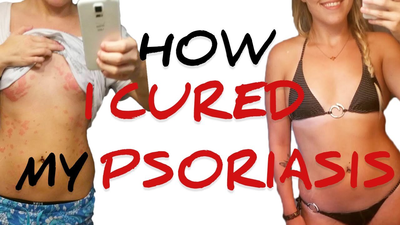 How I CURED My Psoriasis